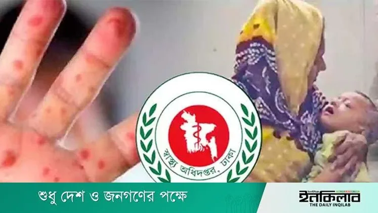 হাম উপসর্গে ২৪ ঘণ্টায় ৪ শিশুর মৃত্যু, ১,৩০৬ সন্দেহজনক রোগী শনাক্ত