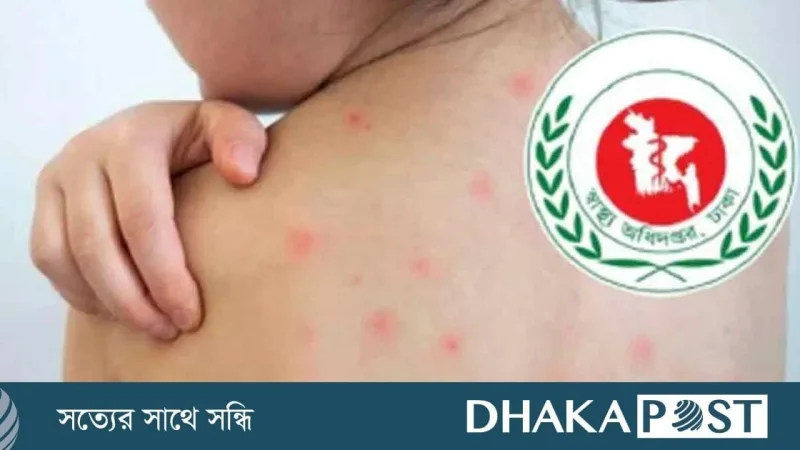 হামের উপসর্গে ২ জনের মৃত্যু, ২৪ ঘণ্টায় ১,০৩২ রোগী ভর্তি